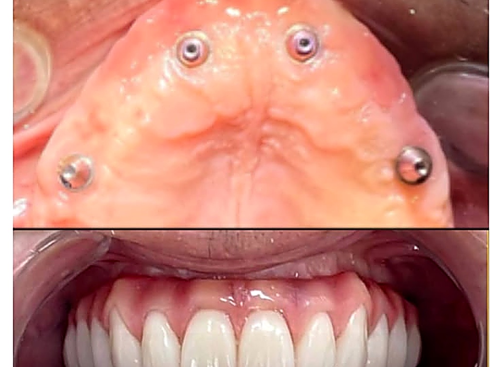 Caso real: implantes superiores e inferiores com protocolo