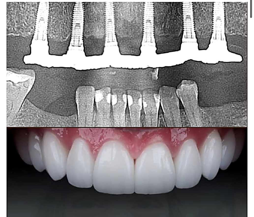 Caso real: implantes superiores com protocolo